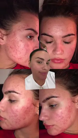 Raw but Real 🫀 PCOS & ENDO Acne issues are REAL, amongst other unpleasant things 🥲 (the list is endless🤦🏻‍♀️) If you dont have a “skin” folder on your phone then congrats 🫠 This picture wasnt even the worst of my hormonal acne, these was somewhat “tamed” 🥹. #pcos #pcosacne #polycysticovariansyndrome #pcosacnestruggles #pcosacnecure #endometriosisawareness #pcosawarenessmonth #pcoslife #pcoshormonebalance #hormoneimbalance #adultacne #pcosjourney 