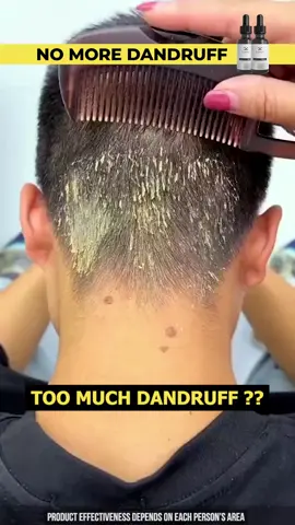 No more dandruff with KASOMO Shampoo #kasomo#dandruff #shampoo #saudi