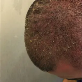 #fpy #foryour #tiktok #dandruff #Extreme #satisfyingvideo #satisfyingsound #foryoupage❤️❤️ #fypシ゚viralvideo #1mview #asmr #capcut