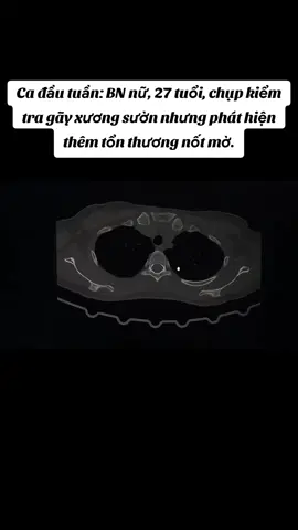 Bệnh nhân nữ, 27 tuổi đau ngực do ngã, đã chụp XQuang không thấy bất thường nay đến chụp CT kiểm tra vô tình phát hiện tổn thương nốt mờ. Chúng tôi khuyên cần kiểm tra 6 tháng-1 năm 1 lần bằng CT phổi liều thấp.  #ct #mri #suckhoe #suckhoelavang 