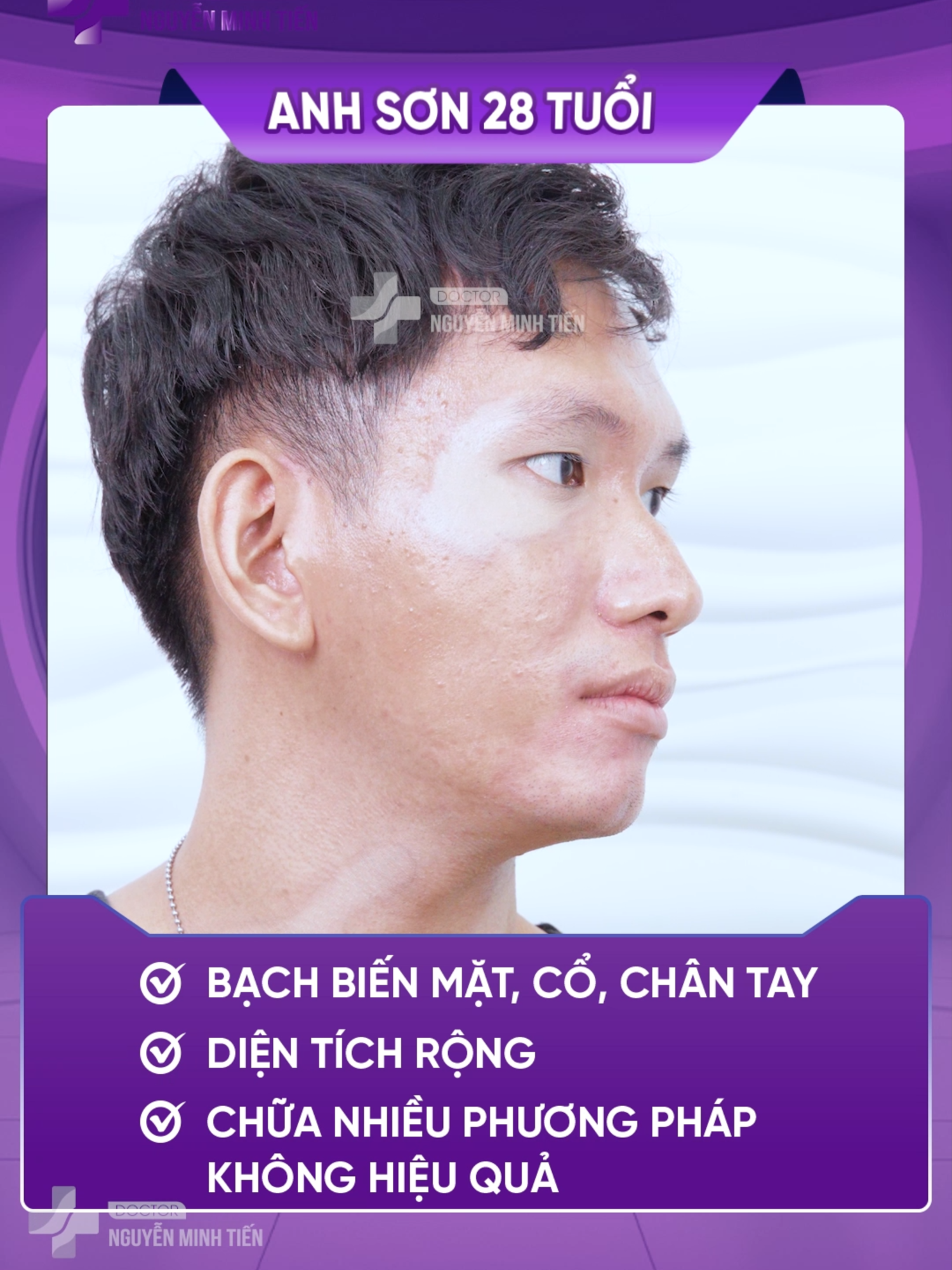 bạch biến, lang ben, vẩy phấn trắng, mất sắc tố da nay đã có công nghệ điều trị sạch tới 90 - 95% - Hiệu quả ngay sau điều trị có văn bản cam kết đồng hành cùng khách hàng trong suốt quá trình trị liệu #bachbien #matsactoda #langben #viendacodia #xuhuong