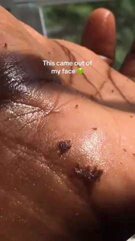 @dr.althea_official did THAT! The Pure Grinding Cleansing Balm went deep to remove my blackheads without me needing to do extractions!#cleansingbalm #skintok #koreantiktok #skincare #blackheadremoval #kbeautyskincare #kbeauty #acneskin #blackheads 