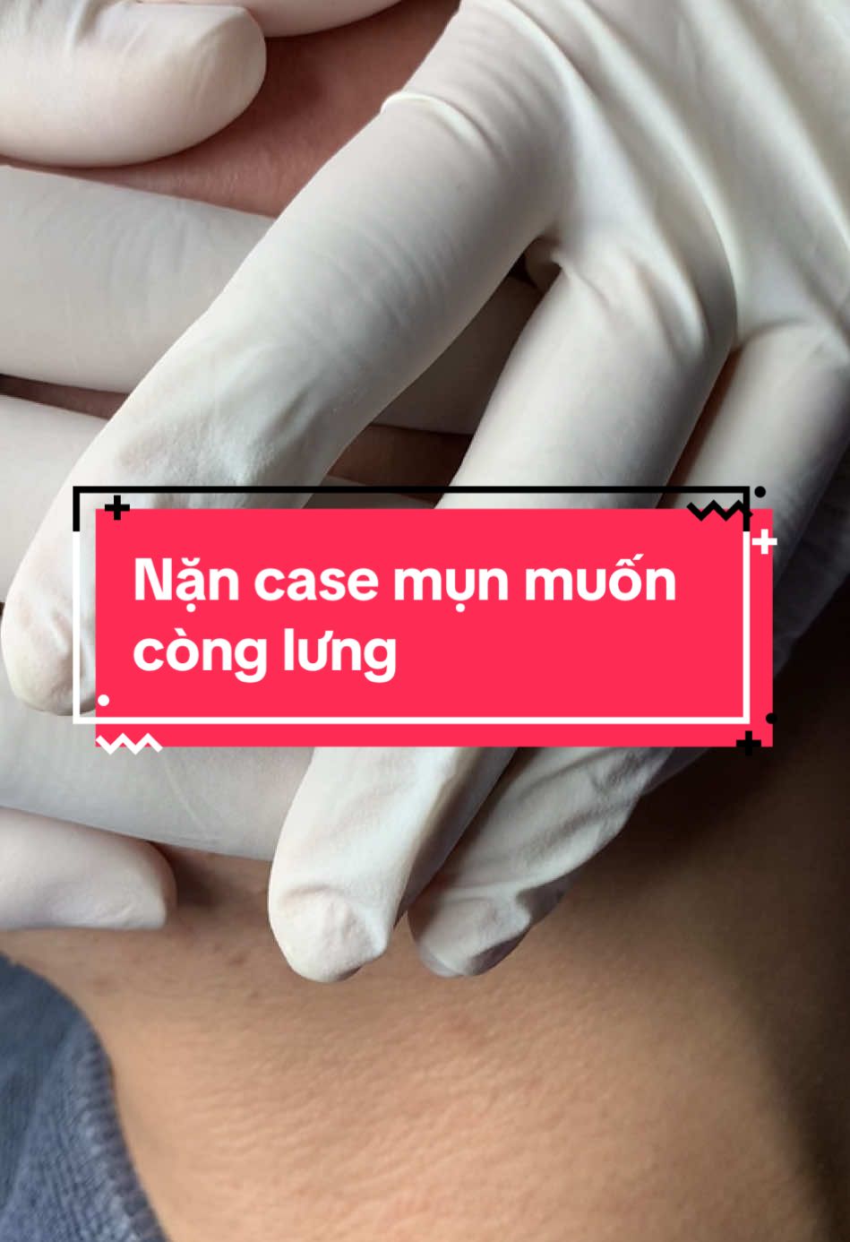 Không skincare khoa học và cái kết #xuhướng #nanmun #nanmunchuanykhoa #nanmunbangtay #dieutrida #nanmunbangtayuytinhanoi #dieutridakhoahoc #fyp #mesotherapy #peel 