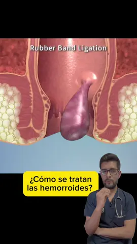 ¿Cómo se tratan las hemorroides? 🚽🩺 #curiosidades #salud  #SabiasQue #medicina 