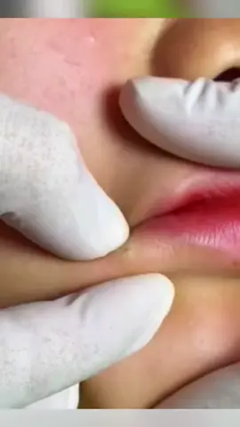 #p#pimplepopper #pimple #pimplepop #pimplepoppers #pimpleremover #pimples #blackhead 