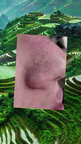 #pimple #acne #pimples #pimplepop #satisfyingvideo #pimplepopper #fyp