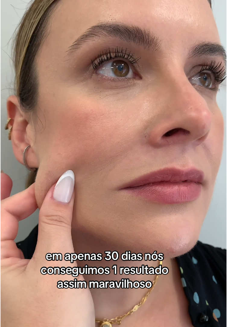 Pele derretida nunca mais 🫠 por isso eu amo esse tratamento ❤️#ultraformer #esteticaavançada 