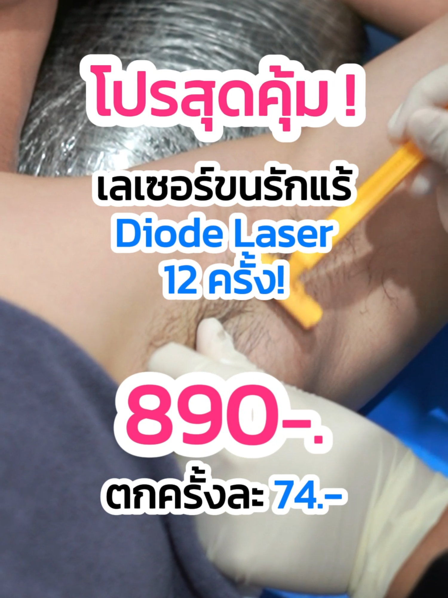 โปรสุดคุ้มเลเซอร์ขนรักแร้ 890.- ตกครั้งละ 74 บาท!!!! 🤩😵🤟 #diodelaser #เลเซอร์3พลังงาน #เลเซอร์ขนรักแร้