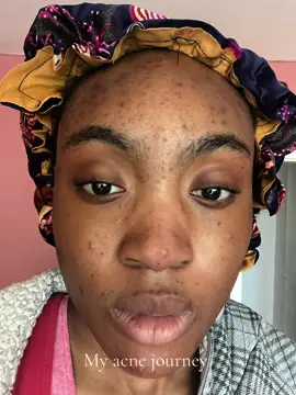 Proof that it gets better 🥹❤️‍🩹❤️‍🩹!! #acne #acnejourney #acneskin #acnescars #skincare #healingskin #fyp #hyperpigmentation #darkspots #nigetiantiktok #nigeria #nigerian #naijatiktok #blackskin #blackskincare #kosmetik #selflove #girlssupportgirls 