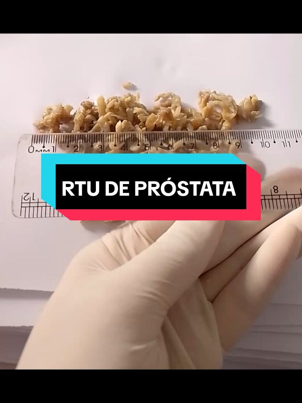 RTU prostático #prostata #rtu #saude #saudedohomem #biomedicina #patologia @Anatomia Patológica 