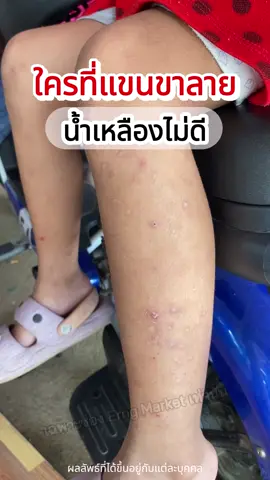 #ขาลาย #น้ําเหลืองไม่ดี #ครีมอัญญาพญายอ #ครีมพญายอพลูคาว #ครีมสมุนไพร #สกินแคร์ #รีวิวบิวตี้ 