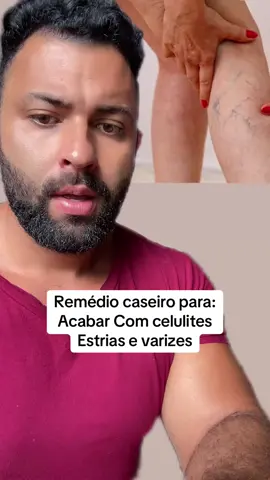 #dicas #dica #varizes #estrias #celulites 