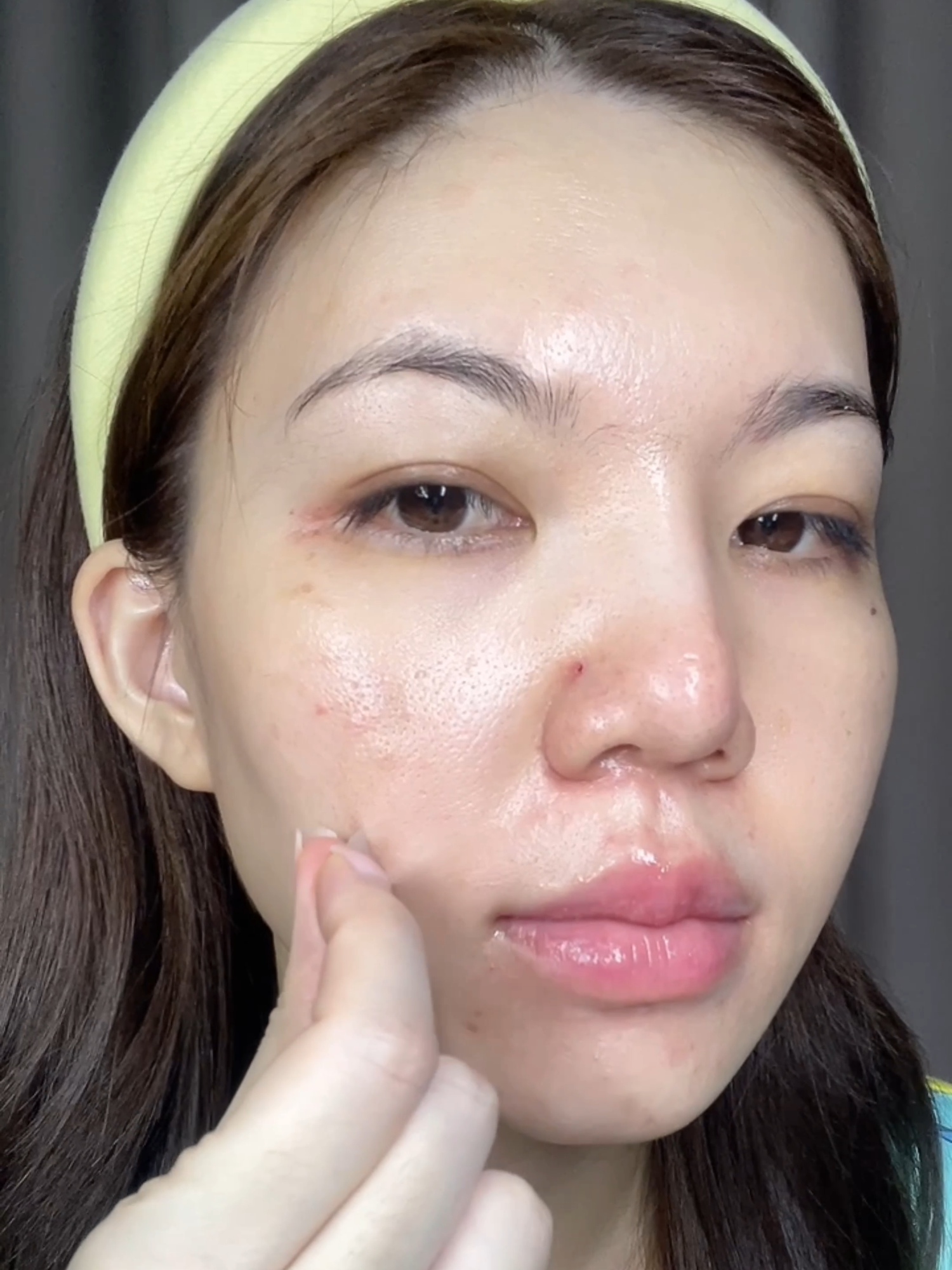 สิวยุบไวมาก เลิศสุดๆ 😍 . #แผ่นแปะสิว #moonshotskincare #theawesomedot #สิว
