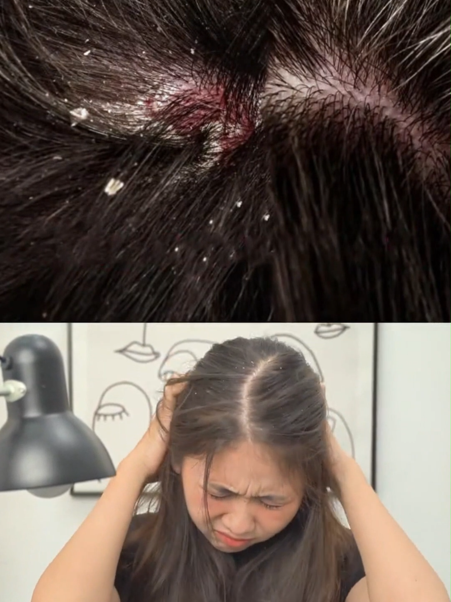 how to cure scalp fungus, seborrheic dermatitis completely at home #timicosmetic #timigroup #scalp fungus #dandruff #scalp infection #semas