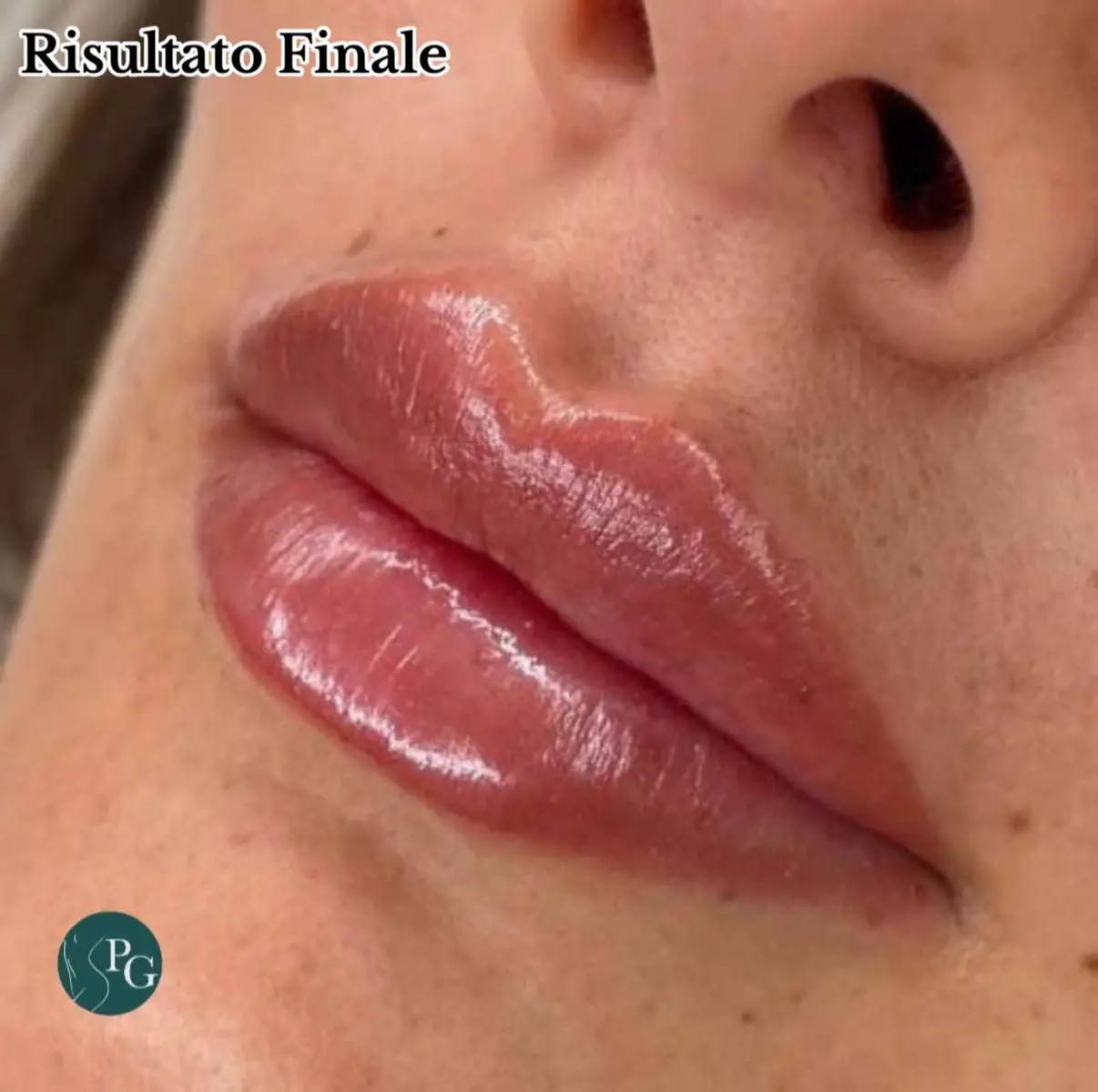 Filler labbra eseguito su paziente con labbra asimmetriche💋 Ti piace questo effetto super naturale? La paziente è entusiasta!😍 📍 Sedi: Caserta / Roma  ☎️Per Info e prenotazioni: 3384942238 ✉️Email:dottgraziano@gmail.com #chirurgiaestetica #medicinaestetica #naturalbeauty #dottpasqualegraziano #roma #caserta 