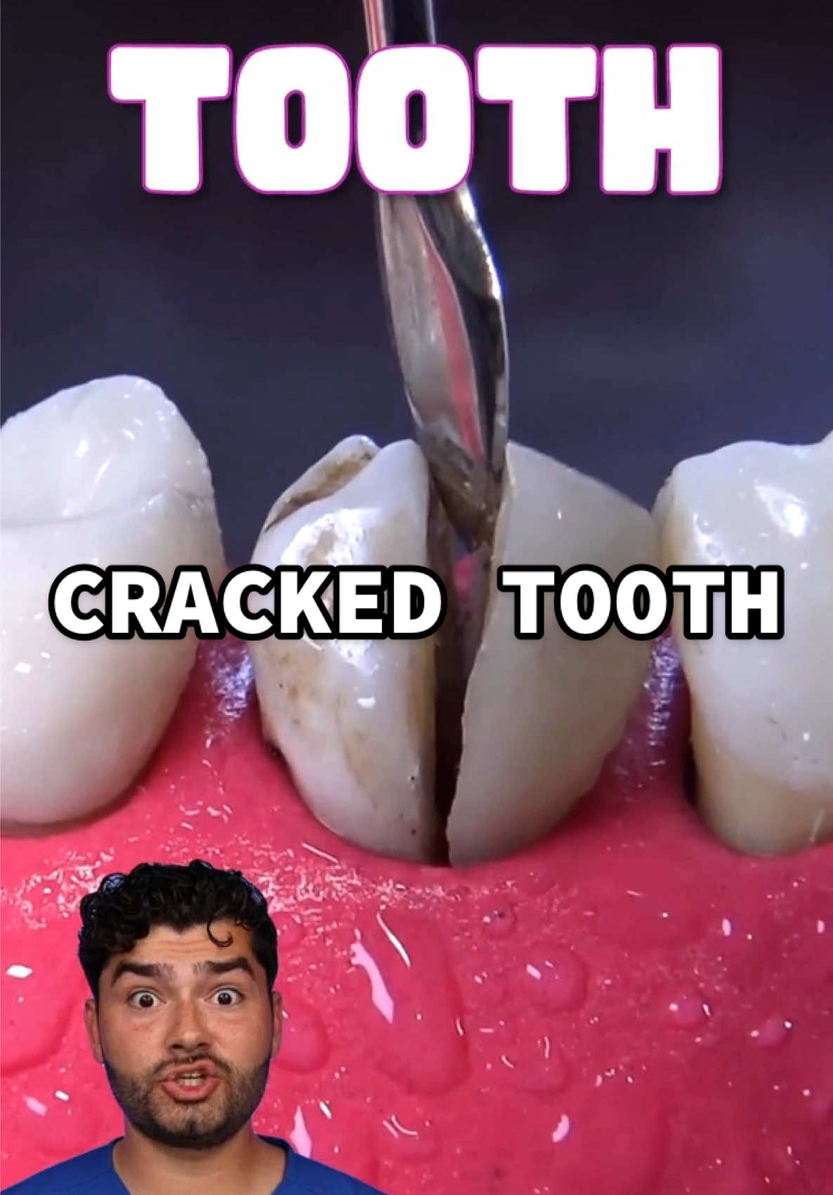 Cracked Tooth!? #dentist #medical #surgery #learn #didyouknow #viral 