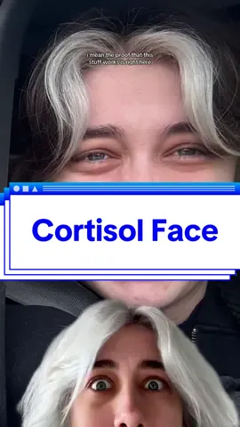 How To Get Rid Of Cortisol Face 😰 #fyp #cortisolface #cortisolmeaning #highcortisol #stress #StressRelief #bodyhacks #bodysigns #lifehacks #tiktokpartner #EduTok #LearnOnTikTok #cortisol #cortisollevels #cortisolimbalance #stresshormones #stressedout #healthy #science #onlyjayus 
