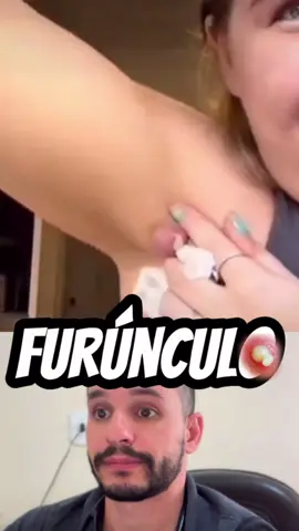 Furúnculo é uma infecção de pele, geralmente causada pela bactéria Staphylococcus aureus, que acomete o folículo piloso (pelo), a glândula sebácea e o tecido ao redor. Surge especialmente nas regiões com pelos e mais expostas à umidade, pressão e atrito, ou a substâncias gordurosas que facilitam a obstrução dos folículos pilosos. Face, pescoço, costas, axilas, coxas e nádegas são as áreas mais vulneráveis. Sintomas: Surge uma lesão endurecida na pele, semelhante a uma espinha, avermelhada, quente e dolorosa que se transforma em um abscesso de pus. Com o tempo, esta lesão amolece e drena o “carnegão” (uma massa de pus misturada com restos de pele). O tamanho do furúnculo varia de acordo com a profundidade dos tecidos infectados. Tratamento: É baseado no uso de antibióticos que atuam contra as bactérias e, só devem ser utilizados sob orientação médica, para evitar o desenvolvimento de resistência a esses medicamentos. Compressas quentes ajudam a acelerar a drenagem e a cura. Em casos mais graves, há necessidade de cortar e drenar o furúnculo cirurgicamente, em uma unidade de saúde. #pele #skincare #furunculo
