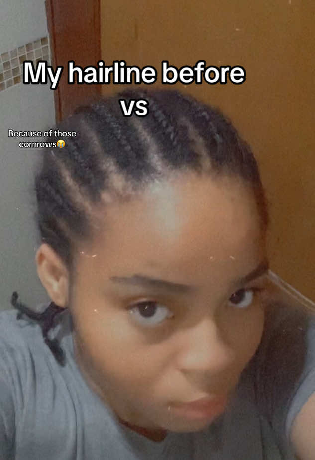 Those cornrows really did me dirty 🙃😑. Btw I posted what I used. It is pinned on my page. #growhairline #growedges #naturalhair #hairgrowth #4chair #washday #minibraids #lengthretention #growhair #edges #babyhair #hairlinecheck #hairline