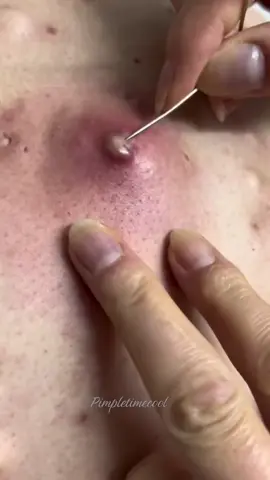 back pimple explosion #pimples #acne #blackheads #pimplepopper 