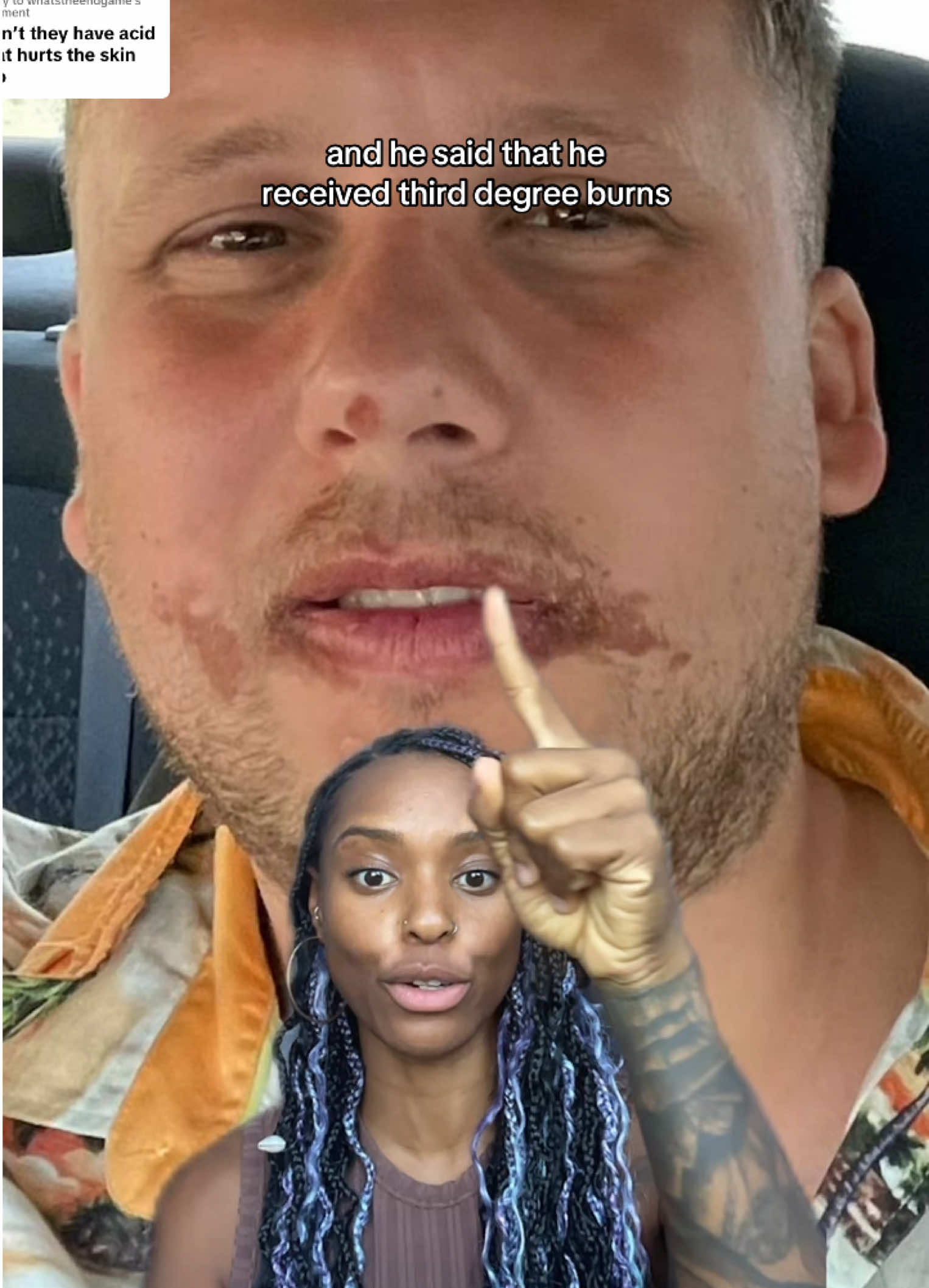 Replying to @whatstheendgame this man from Luton got third degree burns on his face from eating Cashew Nut shell    #cashew #cashewnut #foodindustry #fairtrade #fyp #fruit #food 