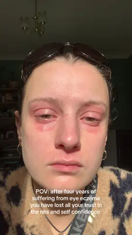 Genuinely the only thing that doesnt irritate it more is Vaseline someone please send me a miracle I feel like I’ve tried everything  #eyeeczema #eczema #eyelideczema #faceeczema #eczemaawareness 