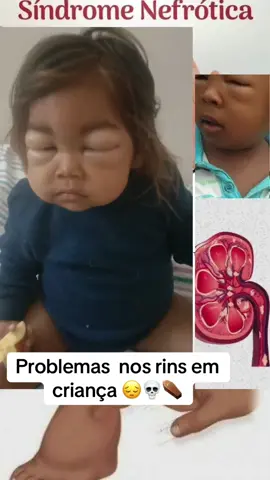Criança inchada 😔💀⚰️ #rins #renal #medico #tratamento #lupus #paciente #hospital #medicina #enfermeria #enfermagem #criança #bebe 