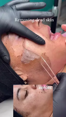 Removing #deadskin in our #chemcialpeel . Client has been #battling with #pigmentation #enlarge pores and #spots . This is day 7 #faceoff .absolutely #Love doing #this #chemicalpeelprocess 