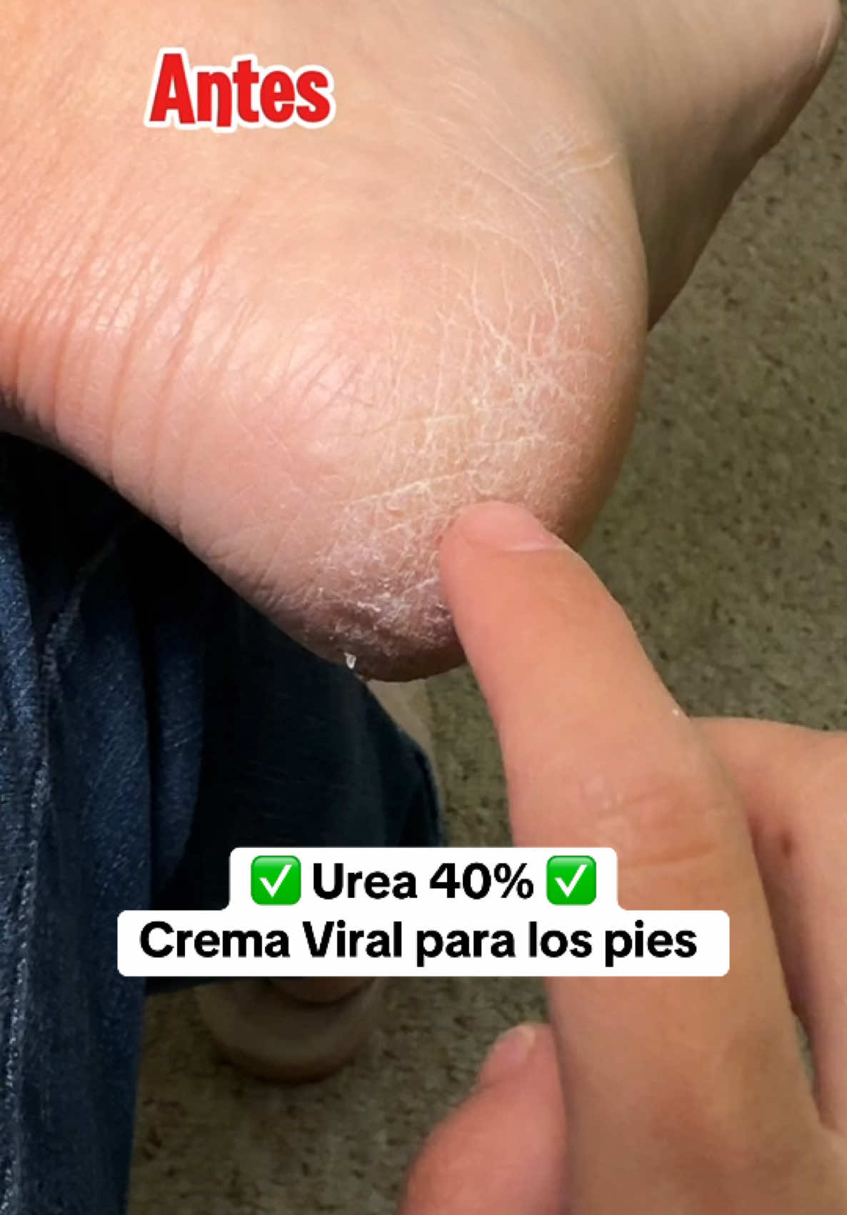 ✨ Urea 40% Feet Cream ✨ Crema para los piel VIRAL 100% recomendada ✅✅✅ #ureacream #urea #footcare #footcareroutine #FallDealsForYou #feetcare  #feetcream  #tiktokshopholidayhaul #tiktokshopblackfriday #tiktokshopcybermonday #urea40cream 