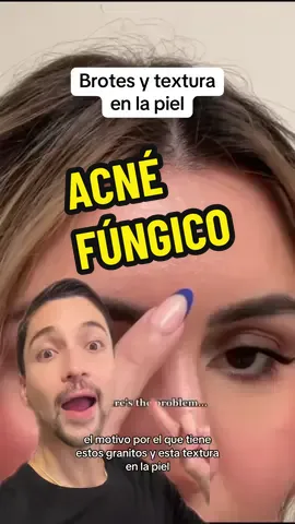 Acné fúngico #skincare #skincaretips #textura #texturaenlapiel #texturedskin #acne #acnetips #acnefungico #malazessia #pityrosporumfolliculitis #azelaico #ketoconazol #barreracutanea #limpiezafacial #hidratacionrostro #greenscreen 