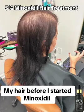 So appreciate that Sefudun 5% Minoxidil helped serious hair loss problem!! 🥹🥹#minoxidil #hairlosssolutions #minoxidilchallenge #fyp #minoxidilresult #hairhacks #hairgrowth #beardgrowth #sufudun 