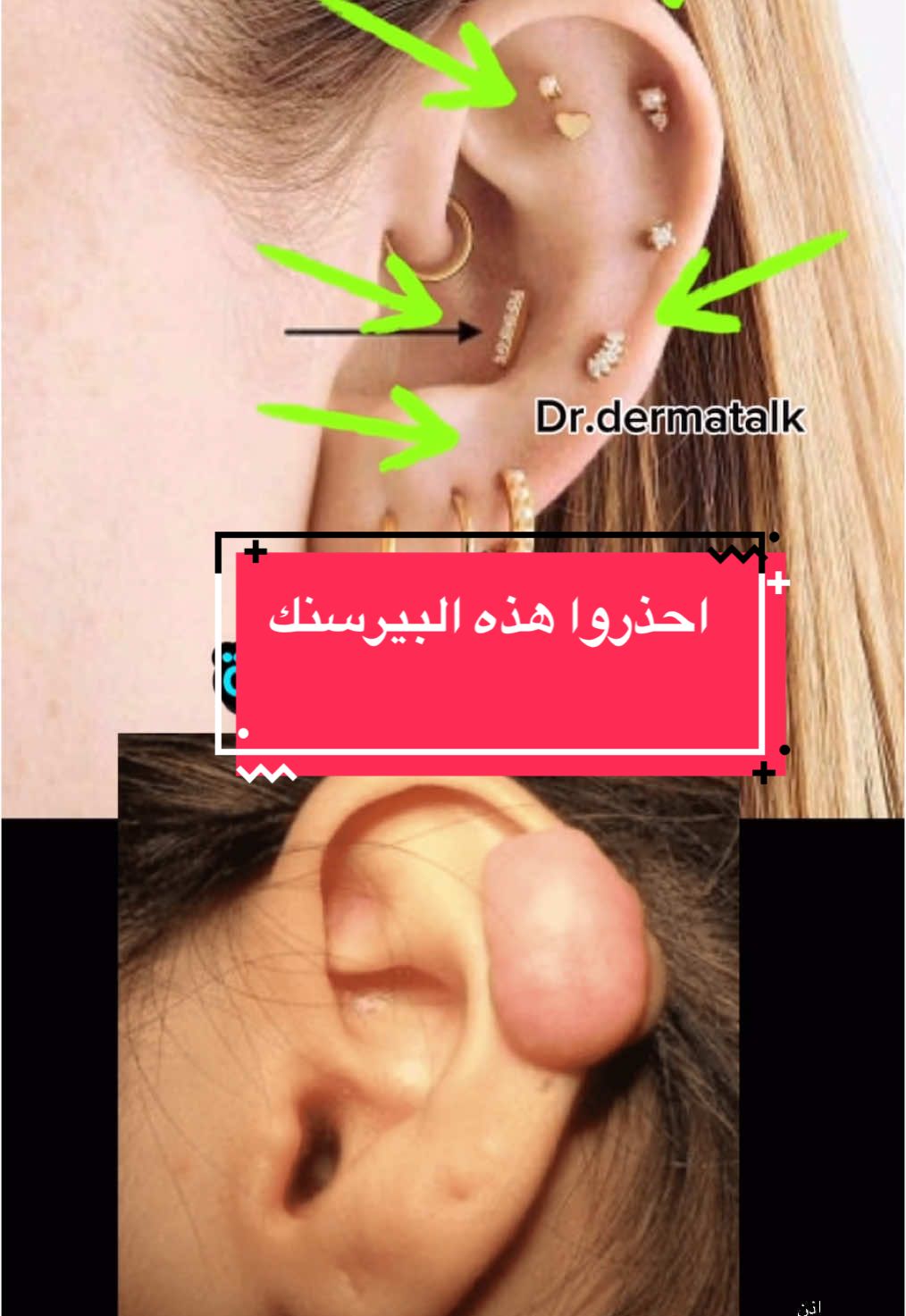 مضاعفات تراجي الاذن #drdermatalk5 #اكسبلورexplore #اكسبلورر #تراجي_ذهب #تراجي_نسائية #ذهب #خرم #الاذن #كيلويد #التهابات_الاذن 