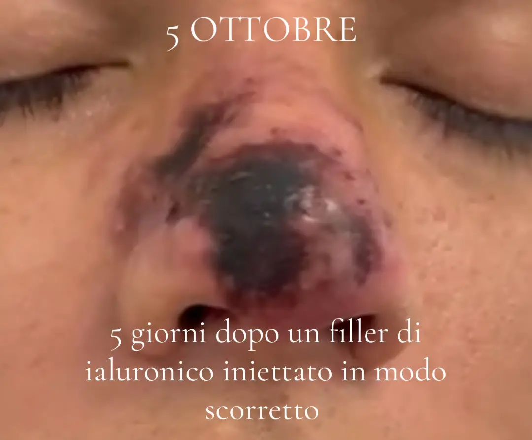 AFFIDATEVI SEMPRE E SOLO AL PERSONALE ESPERTO!!!  5 ottobre abbiamo ricevuto un paziente che presentava una necrosi della punta del naso dopo un rinofiller eseguito male da un medico abusivo. Subito abbiamo iniziato la terapia con la ialuronidasi e la terapia farmacologica. Il prossimo incontro 30 ottobre. Vi aggiorneremo con i progressi. #necrosis #rinofiller #acidoialuronico #clinicamedicalgroup #drgallo #popolodellepunture #acidhyaluronic #medicinaestetica #milano #perte 
