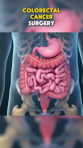 Colorectal Cancer Surgery  #medical #medical3danimation #medical3d #colorectacancer #colorectasurgeon #colorectasurgeon🥲 #colonia #colonsurgery #colonsurgeryprep #colonsurgeryrecovery #erickbriancolon #colonias #colonization 
