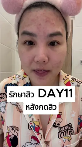 รักษาสิว Day 11 หลังกดสิวทันที ทาสกินแคร์เซตปราบสิวและวิตามินอาหารเสริมลดสิวของหมอเนม #สิว #acne #รักษาสิว #ลดสิว #สกินแคร์ #skincare #แพนฮีโร่ของคนเป็นสิว #ครีมหมอเนม #สิวอุดตัน #สิวอักเสบ