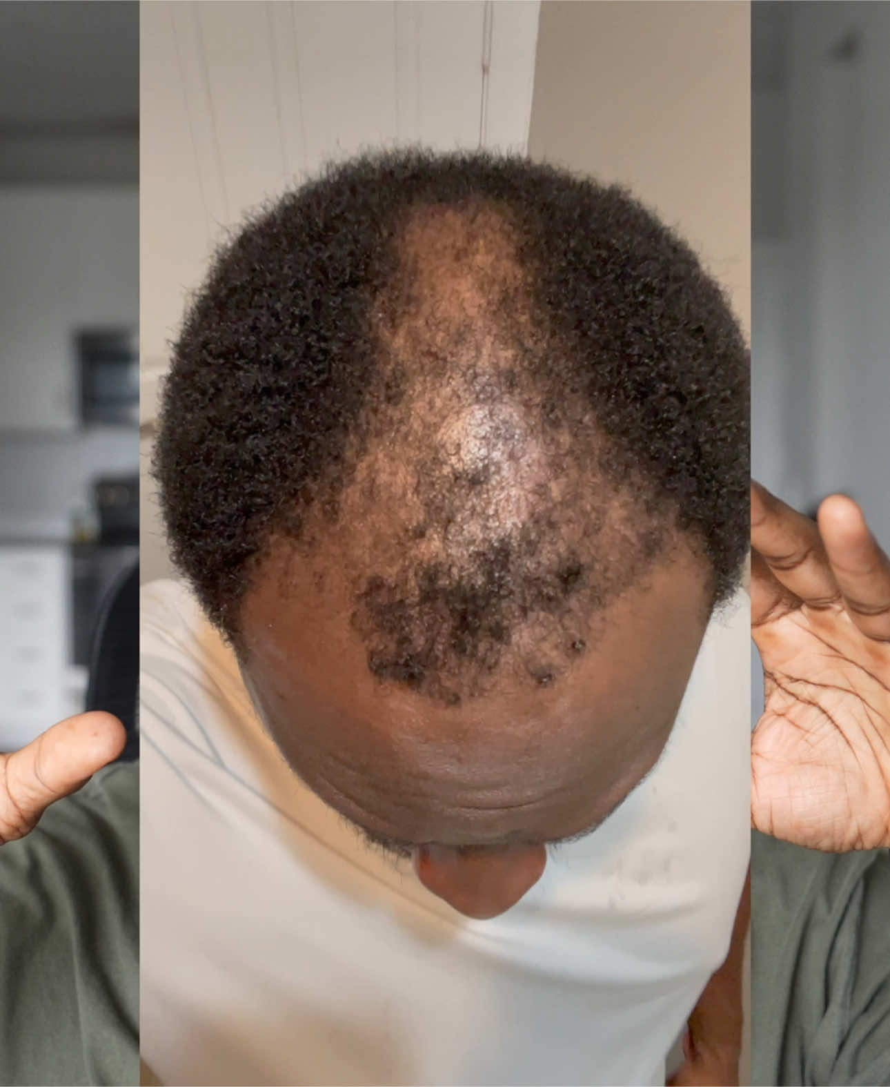 Getting a hair transplant was theeee BEST DECISION OF MY LIFE!!! #fyp #hairtransplant #blackmen #afrohair #blackhair #hairgrowth #hairloss #locs #barreltwists #afro #hairstyles #hairstyle 