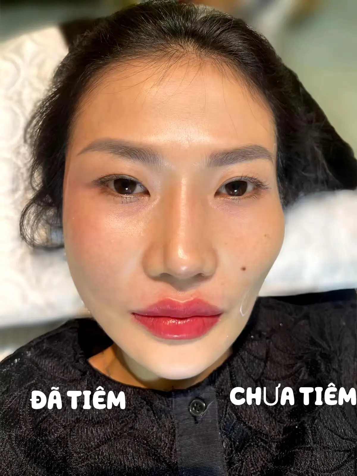 Môi nhà Zoyce 🥰 Đặt lịch qua Top Top vẫn ok nhé mn - 5 suất giảm 20/10 chỉ 999 con cá 🐠 #filler #Botox #tiêmmoi #zoycebeautyspa