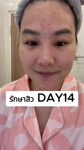 รักษาสิว Day 14 ทาสกินแคร์เซตปราบสิวและวิตามินอาหารเสริมลดสิวของหมอเนม #สิว #acne #รักษาสิว #ลดสิว #สกินแคร์ #skincare #แพนฮีโร่ของคนเป็นสิว #ครีมหมอเนม #สิวอุดตัน #สิวอักเสบ