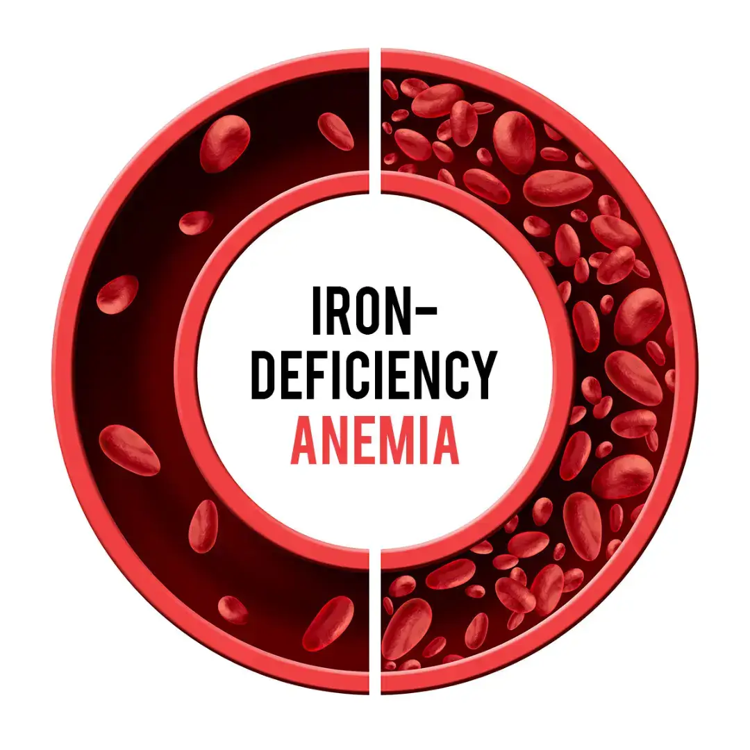 iron deficiency anemia short notes  #medstudent #doctorsoftiktok #medicne #mbbslife💊 #mugadisho🇸🇴 