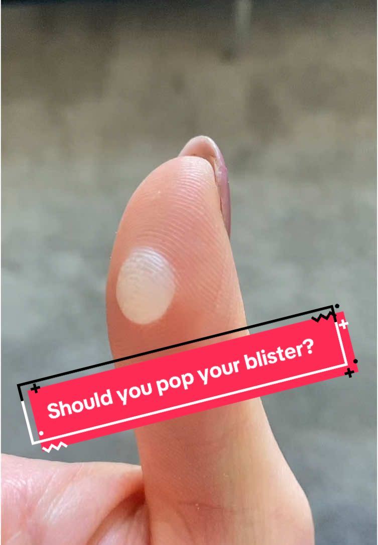 Blisters can be caused by various reasons (commonly caused by friction), but should be left alone to go through their natural process (can take about 3-7 days). So, as best as you can, LEAVE IT! Lol I know its hard. #occupationaltherapy #handtherapy #woundcare #blister 