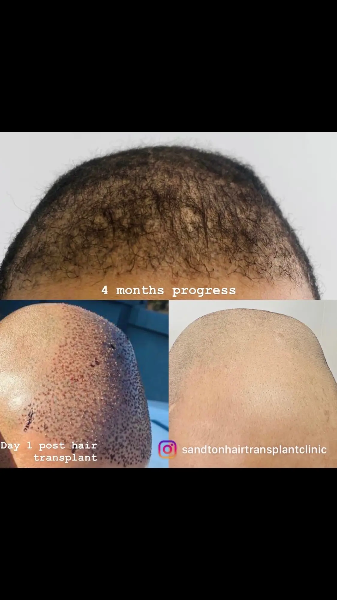 HAIR TRANSPLANT 4 MONTHS UPDATE🔥 The hair transplant process typically follows this timeline: 1. 2-3 Weeks Post-Transplant: It’s normal for transplanted hair to fall out during this period. 2. 3 Months: New hair begins to grow, but the results may still be moderate. 3. 6 Months: Improvement becomes more noticeable, with good results starting to appear. 4. 1 Year: Final and optimal results are usually achieved at this stage.  If you have any further questions about the process, feel free to ask! 📲 0727230690 or 0727398410 for bookings or enquiries 📍11 Amalinda Street   Sandown   Sandton