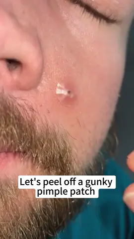 best pimple patch？#pimplepatch #skinacne #skin #fypシ゚ #smoothskin 