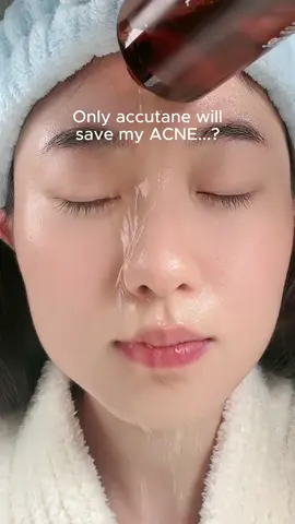 Say goodbye to acne with this toner✨🙌🏻 #skincare #kbeauty #koreanskincare #koreanbeauty #glassskin #acne #acnetreatment #acneproneskin #fyp  @acwell_official 