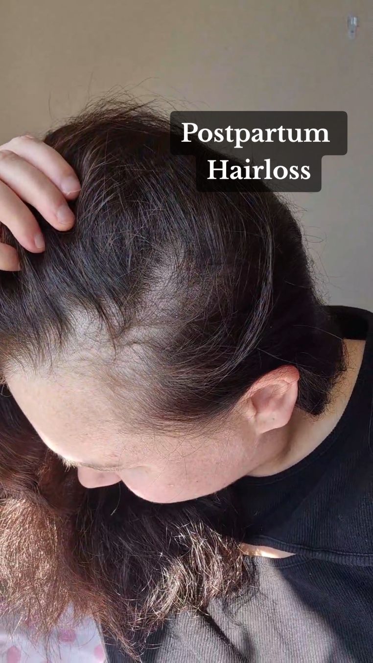 On a mission to elevate kiwi mums going through postpartum hairloss. 🌐elevana.co.nz  #postpartumhairloss #postpartum #hairgrowth #rosemaryoil #newmum #mumhair #hairtreatment #hairloss #nzmum #hairtok