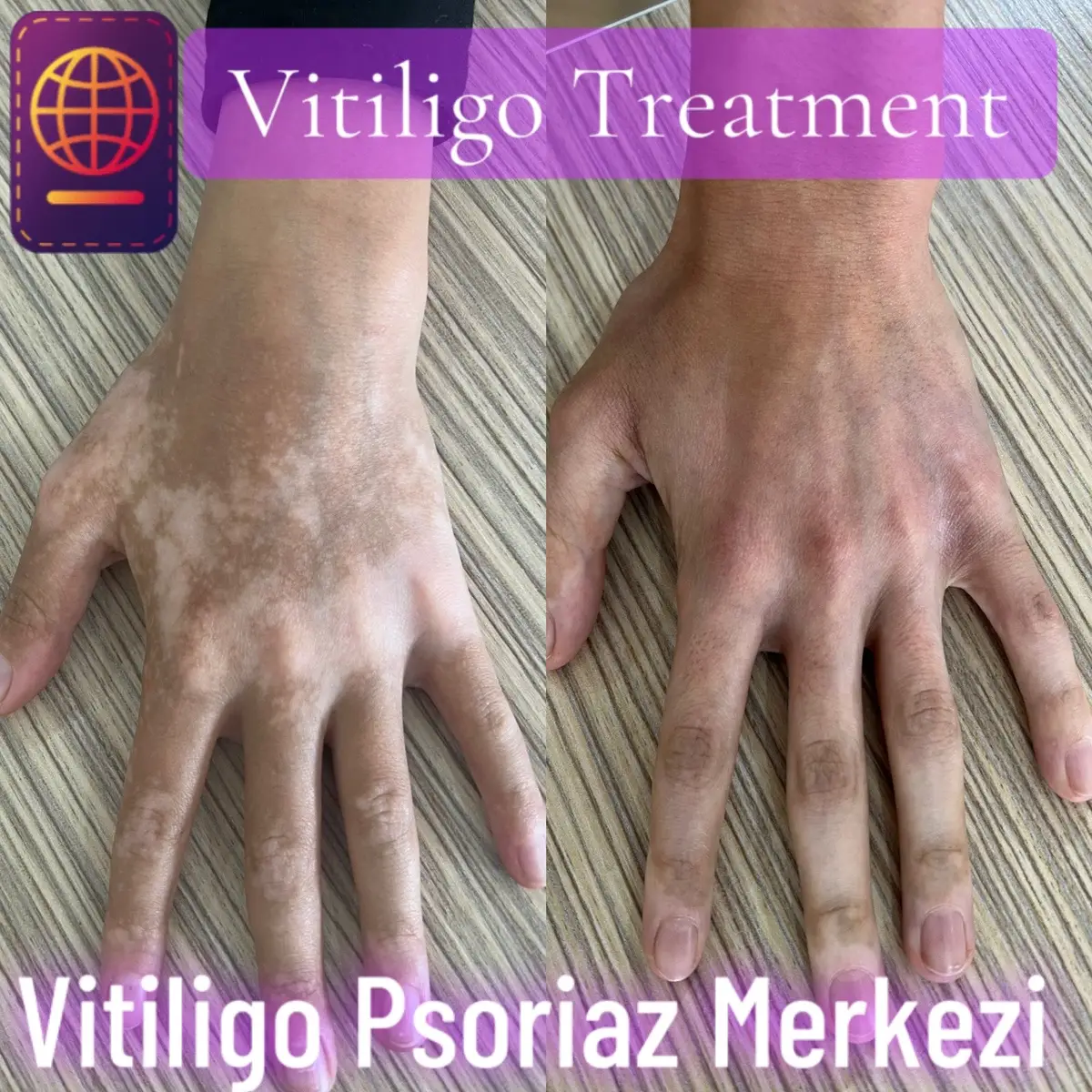 #vitiligo #dermatologist #permanent #pigmentation #makeup #psoriasis #camouflage #treatment 