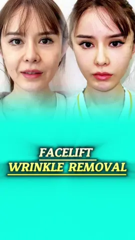 Facelift by Dr. Jong for total facial rejuvenation. #facelift #rejuvenation #surgery #tiktokmalaysia #kualalumpur #malaysia #drjong 
