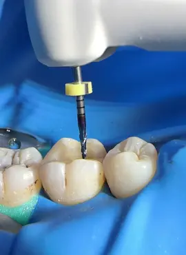 Kanal tedavisi #dentist #dentistryworld #dentista #dentistry #rubberdam #teeth #diş #rootcanal #rootcanaltreatment #kanaltedavisi 