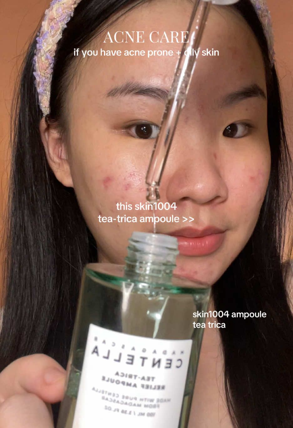 if you have acne prone & oily skin, you should try this skin1004 tea-trica ampoule… SO UNDERRATED! helps to soothe & calm acne and irritated skin. 💚💯 #acneskincare #acnetreatment #skin1004ampoule #teatrica #skin1004 #kbeauty #koreanskincare #acneskin 