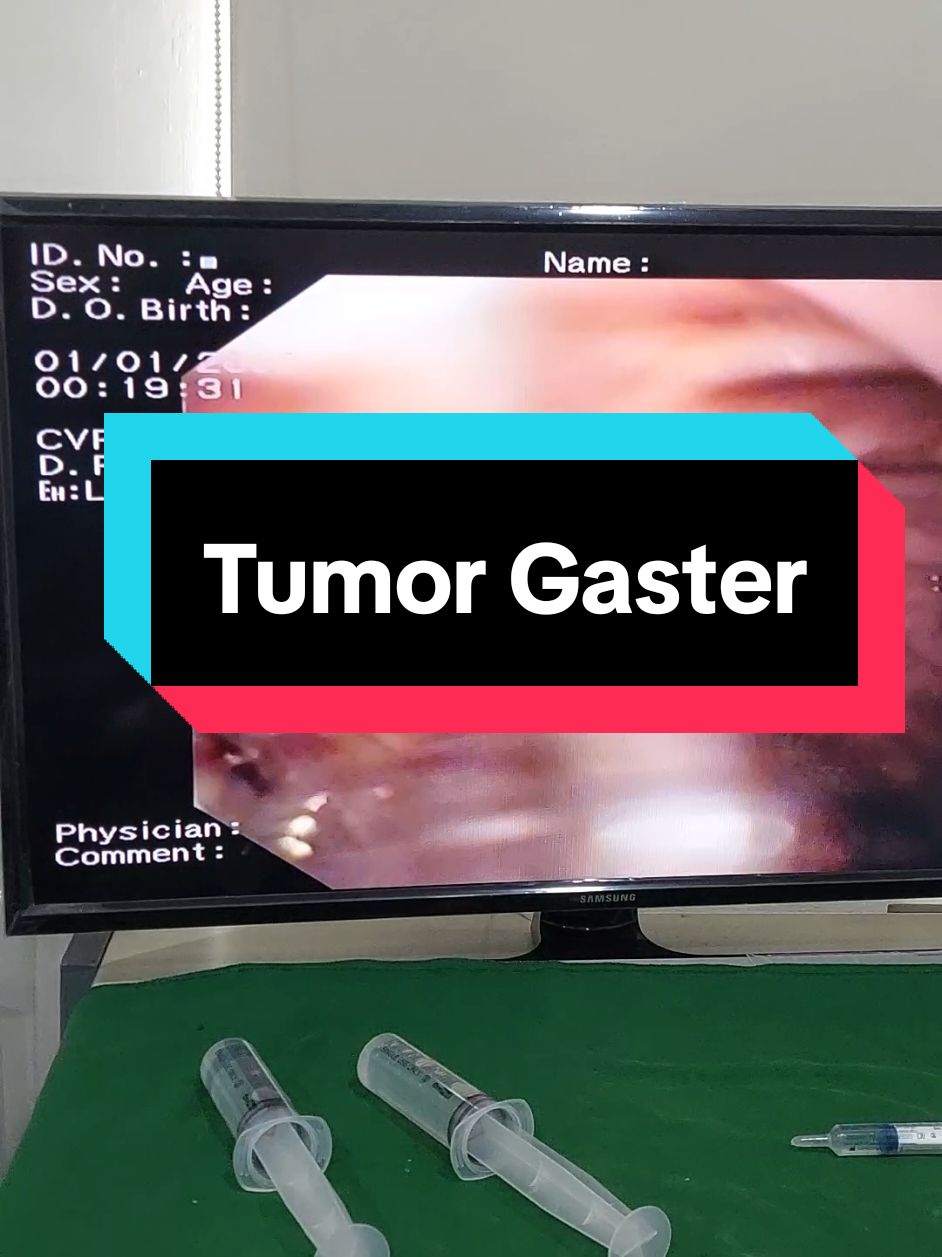 Tumor gaster atau tumor lambung adalah pertumbuhan sel-sel lambung yang tidak terkontrol. Kanker lambung merupakan salah satu jenis tumor gaster yang bisa berkembang di dalam lambung. @religuspinem  @resa_110198  @trias383  #fyp  #tumorlambung  #rsuipi  #edukasikesehatan 