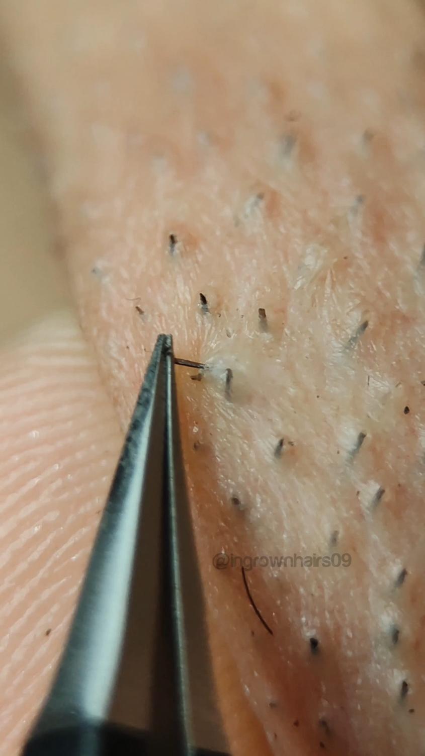 oddly satisfying ingrown hair extractions up close!🫶🏼 #ingrownhair #satisfyingvideo #extractions #relax #asmr #trichotillomania #tweezers #ingrownhairremoval #hairpulling 